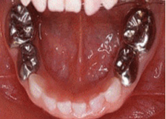 乳歯冠（大きい虫歯）